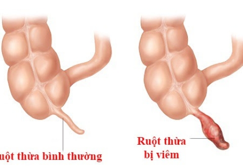 Người bệnh cần làm gì nếu nghi ngờ viêm ruột thừa?